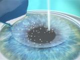 LASIK