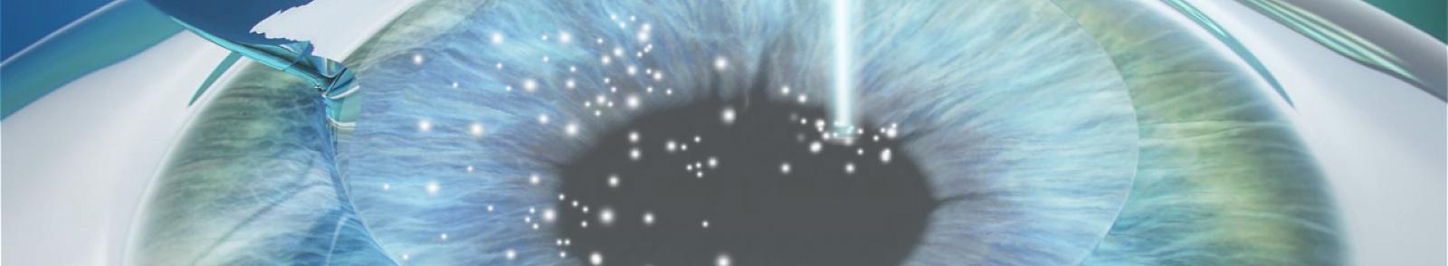 lasik.jpg Header afbeelding